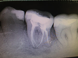 molar