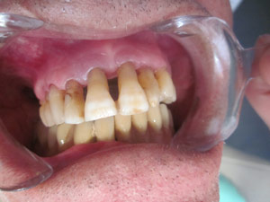 splint-1