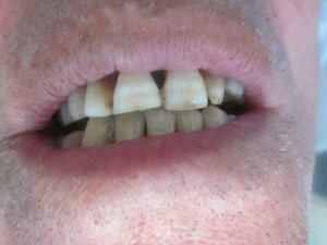 splint-2